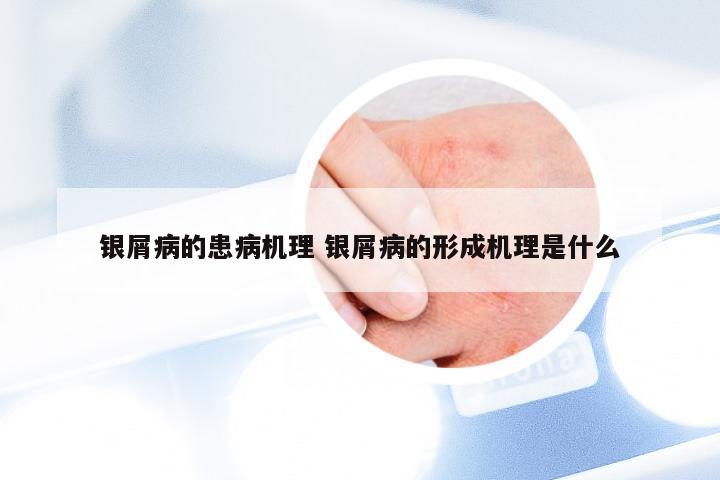 银屑病的患病机理 银屑病的形成机理是什么