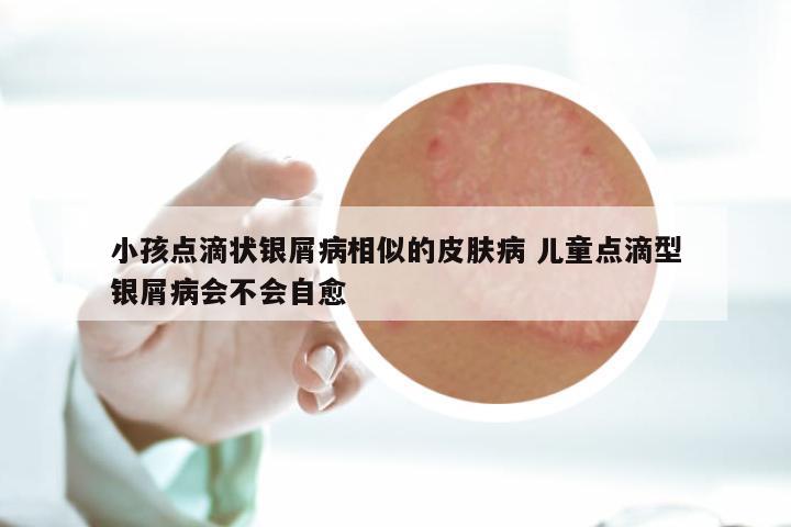 小孩点滴状银屑病相似的皮肤病 儿童点滴型银屑病会不会自愈