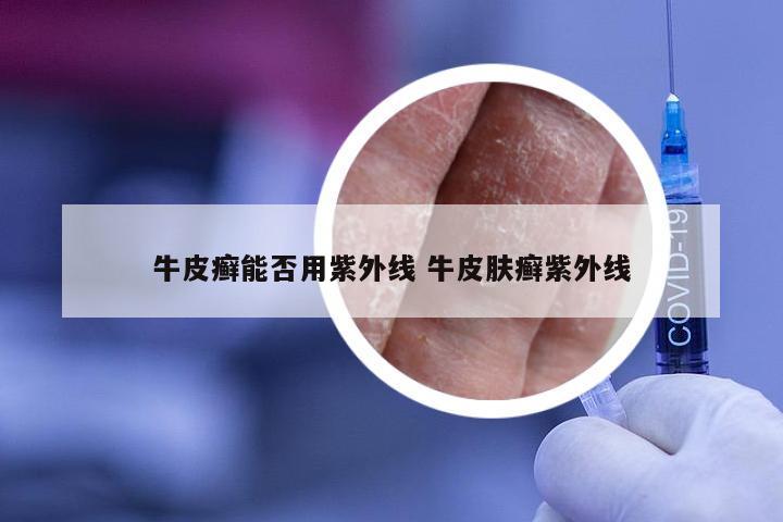 牛皮癣能否用紫外线 牛皮肤癣紫外线