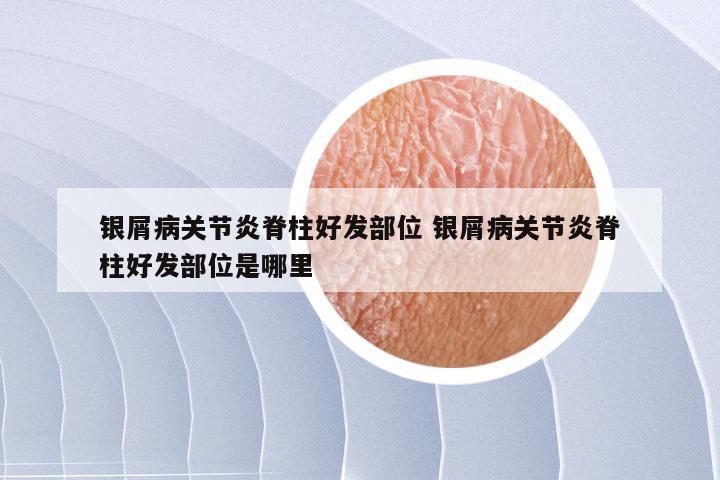 银屑病关节炎脊柱好发部位 银屑病关节炎脊柱好发部位是哪里