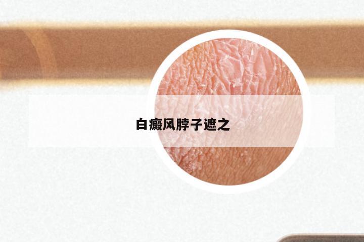 白癜风脖子遮之