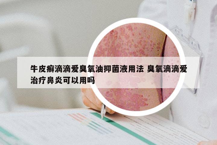 牛皮癣滴滴爱臭氧油抑菌液用法 臭氧滴滴爱治疗鼻炎可以用吗