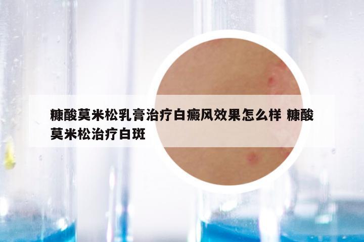 糠酸莫米松乳膏治疗白癜风效果怎么样 糠酸莫米松治疗白斑