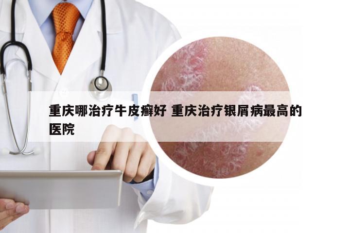 重庆哪治疗牛皮癣好 重庆治疗银屑病最高的医院