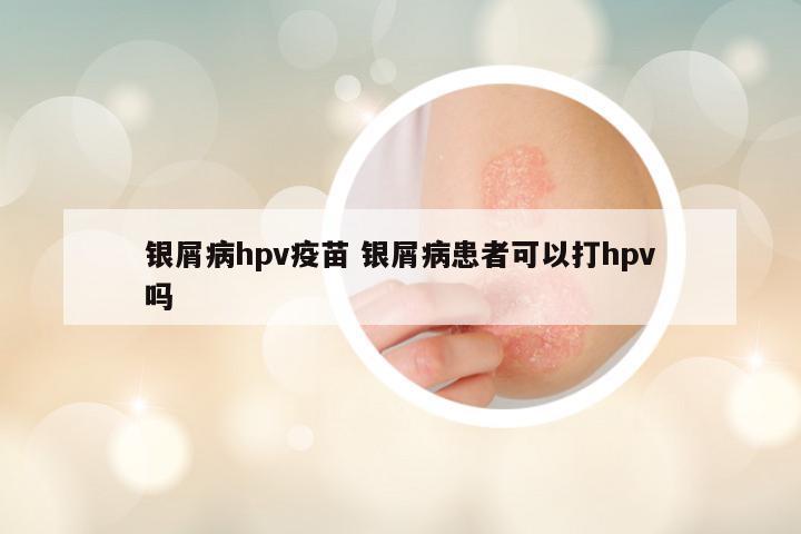 银屑病hpv疫苗 银屑病患者可以打hpv吗