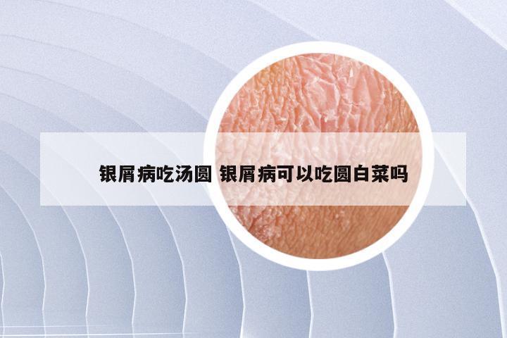 银屑病吃汤圆 银屑病可以吃圆白菜吗