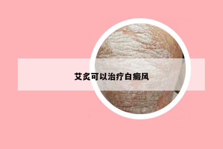 艾炙可以治疗白癜风