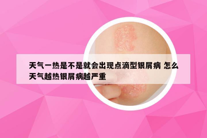 天气一热是不是就会出现点滴型银屑病 怎么天气越热银屑病越严重