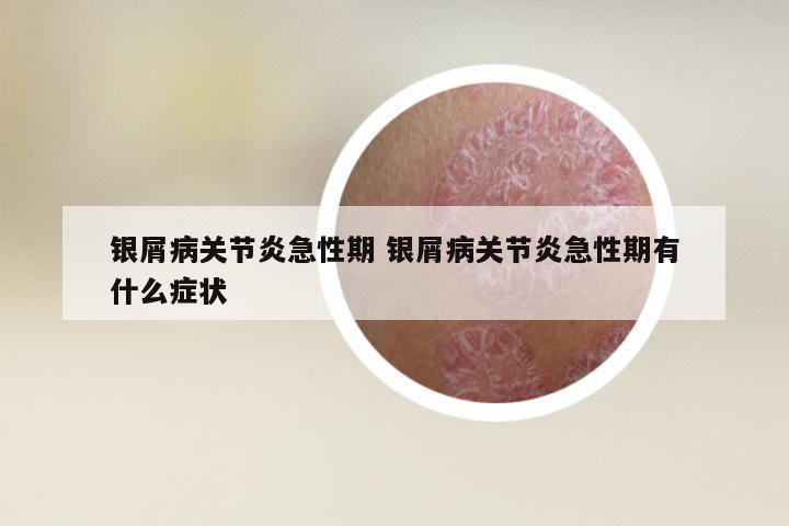 银屑病关节炎急性期 银屑病关节炎急性期有什么症状