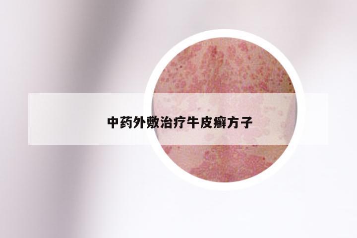 中药外敷治疗牛皮癣方子