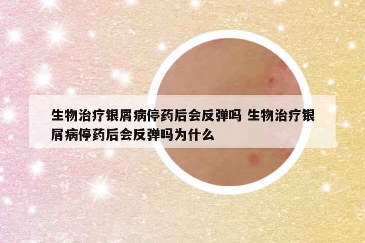 生物治疗银屑病停药后会反弹吗 生物治疗银屑病停药后会反弹吗为什么
