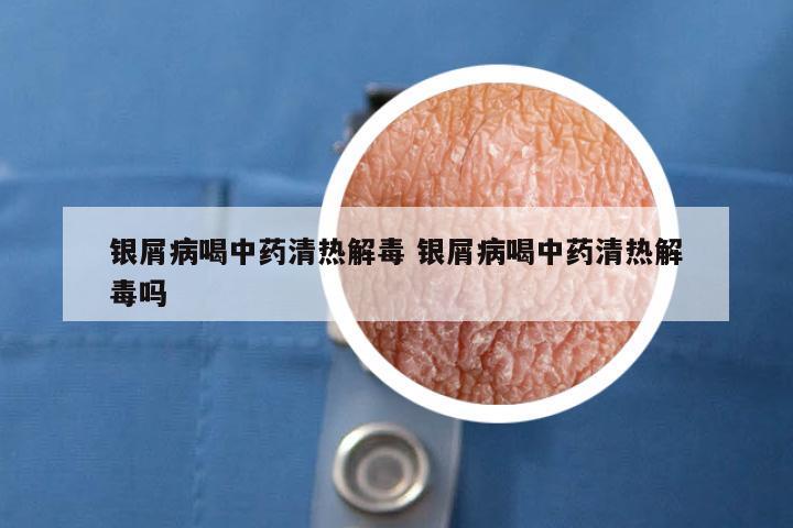 银屑病喝中药清热解毒 银屑病喝中药清热解毒吗