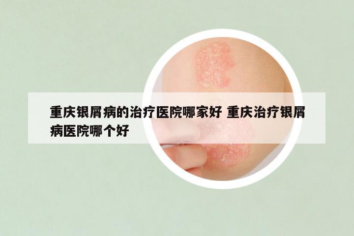 重庆银屑病的治疗医院哪家好 重庆治疗银屑病医院哪个好