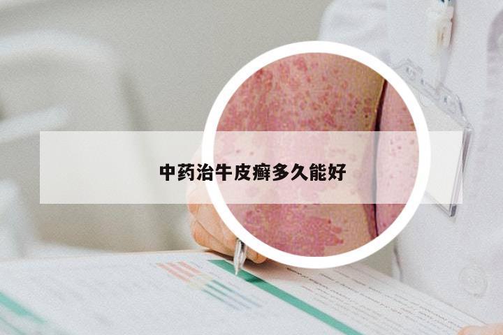 中药治牛皮癣多久能好