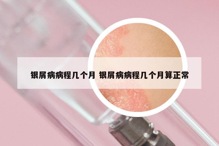 银屑病病程几个月 银屑病病程几个月算正常
