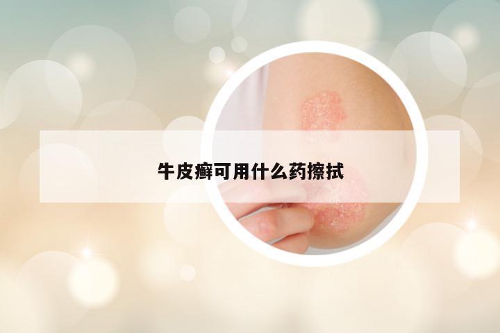 牛皮癣可用什么药擦拭