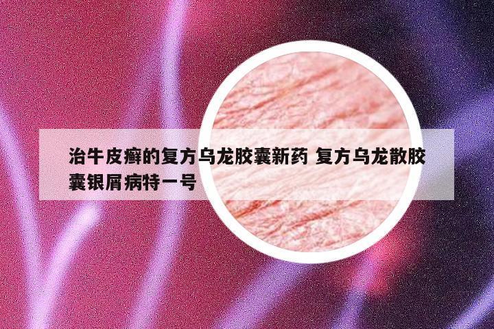 治牛皮癣的复方乌龙胶囊新药 复方乌龙散胶囊银屑病特一号