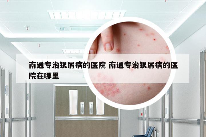 南通专治银屑病的医院 南通专治银屑病的医院在哪里