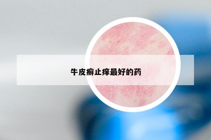 牛皮癣止痒最好的药