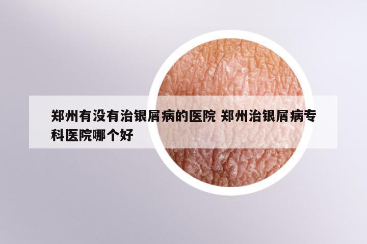 郑州有没有治银屑病的医院 郑州治银屑病专科医院哪个好