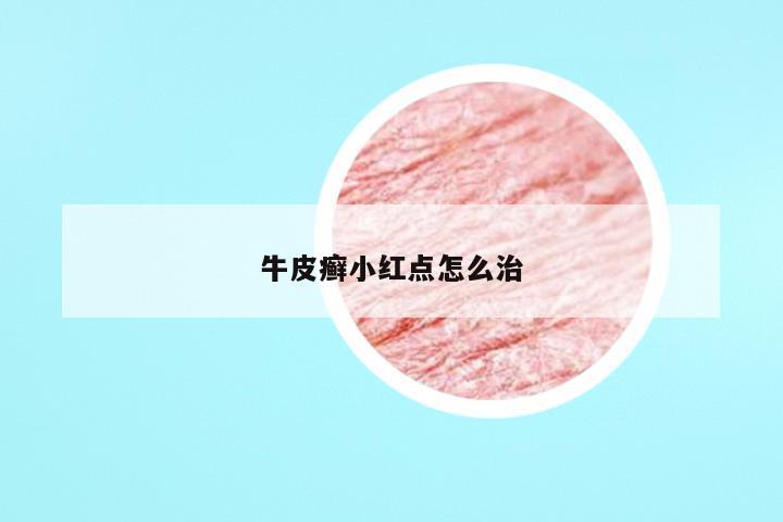 牛皮癣小红点怎么治