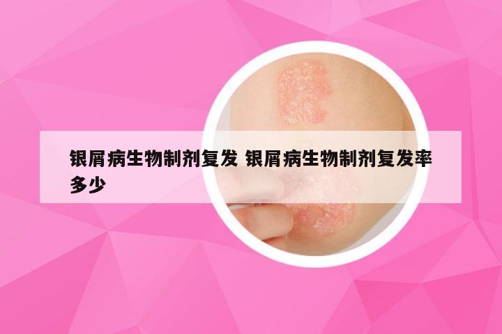 银屑病生物制剂复发 银屑病生物制剂复发率多少