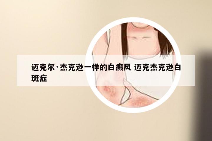 迈克尔·杰克逊一样的白癜风 迈克杰克逊白斑症