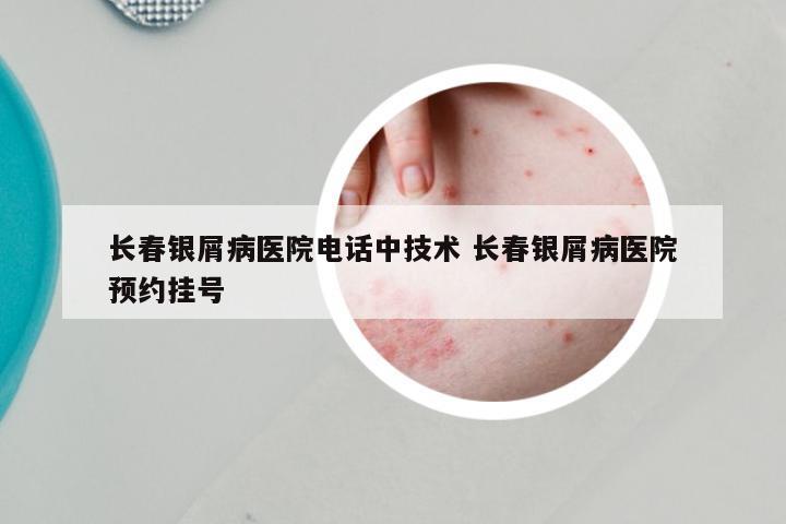 长春银屑病医院电话中技术 长春银屑病医院预约挂号