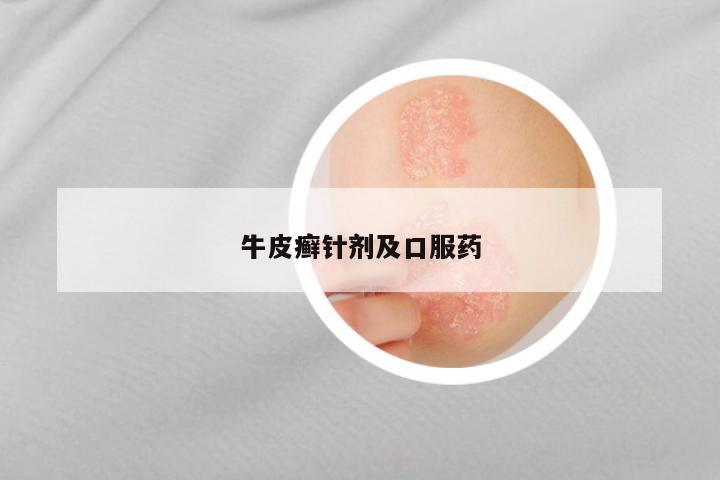 牛皮癣针剂及口服药