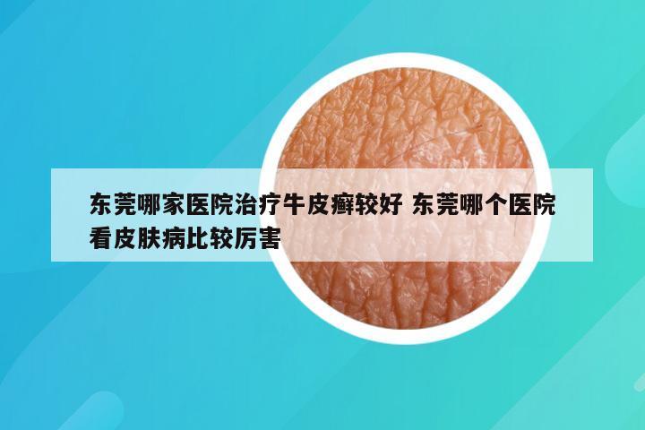 东莞哪家医院治疗牛皮癣较好 东莞哪个医院看皮肤病比较厉害