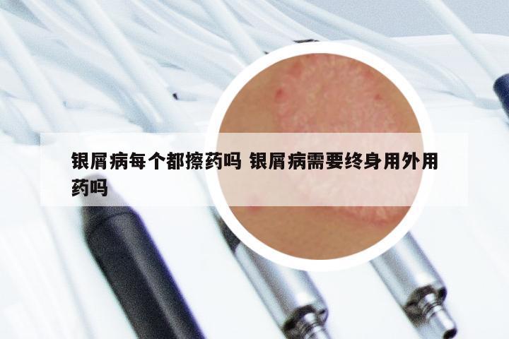 银屑病每个都擦药吗 银屑病需要终身用外用药吗