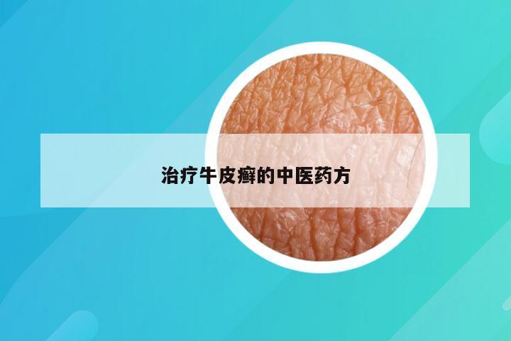 治疗牛皮癣的中医药方