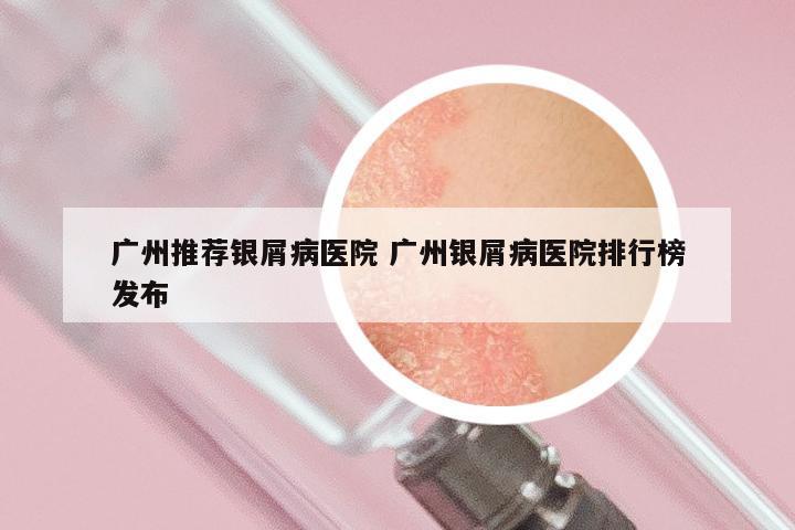 广州推荐银屑病医院 广州银屑病医院排行榜发布