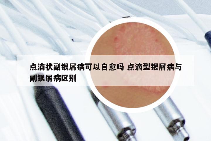 点滴状副银屑病可以自愈吗 点滴型银屑病与副银屑病区别