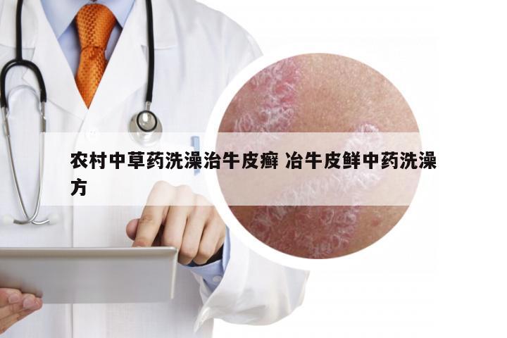 农村中草药洗澡治牛皮癣 冶牛皮鲜中药洗澡方