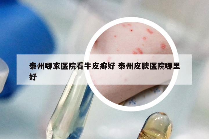 泰州哪家医院看牛皮癣好 泰州皮肤医院哪里好