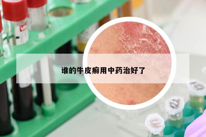 谁的牛皮癣用中药治好了