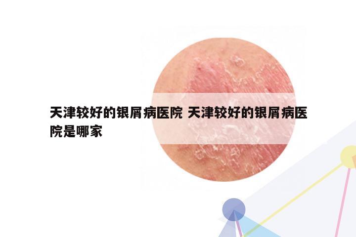 天津较好的银屑病医院 天津较好的银屑病医院是哪家