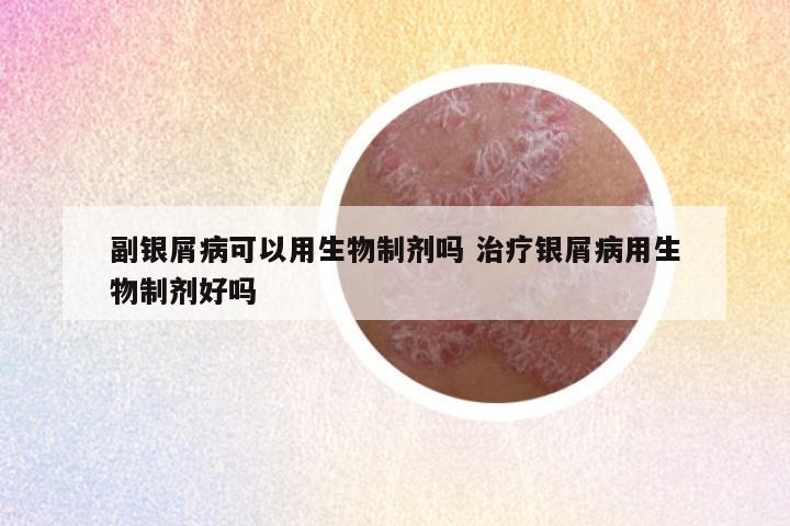 副银屑病可以用生物制剂吗 治疗银屑病用生物制剂好吗