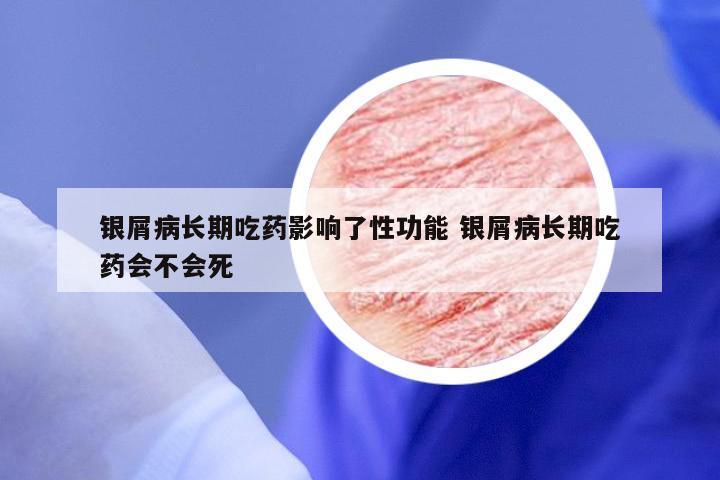 银屑病长期吃药影响了性功能 银屑病长期吃药会不会死