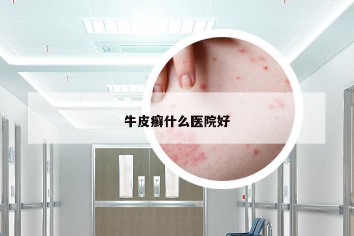 牛皮癣什么医院好