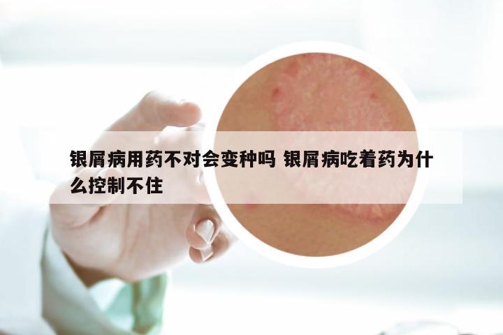 银屑病用药不对会变种吗 银屑病吃着药为什么控制不住