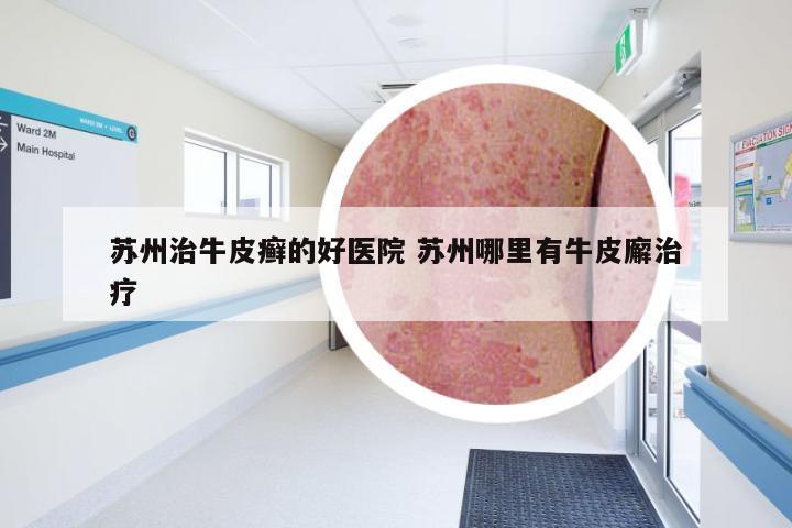 苏州治牛皮癣的好医院 苏州哪里有牛皮廨治疗