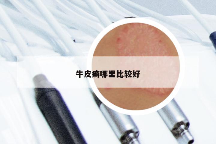牛皮癣哪里比较好