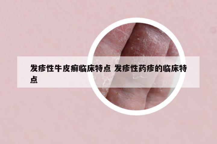 发疹性牛皮癣临床特点 发疹性药疹的临床特点