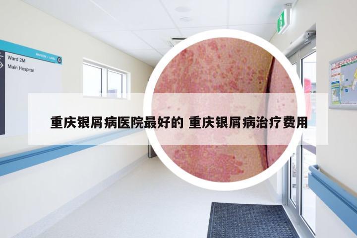 重庆银屑病医院最好的 重庆银屑病治疗费用