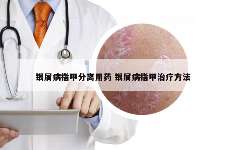 银屑病指甲分离用药 银屑病指甲治疗方法
