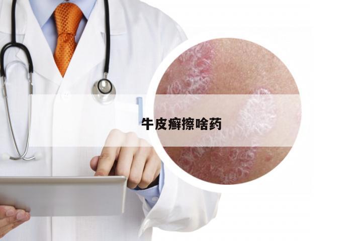 牛皮癣擦啥药