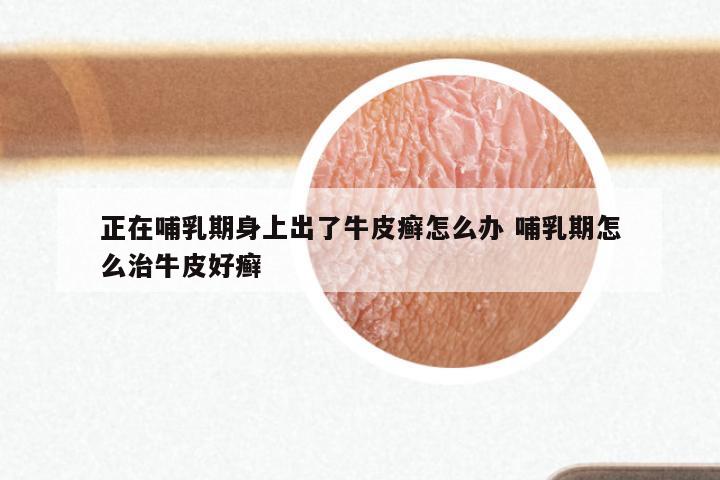 正在哺乳期身上出了牛皮癣怎么办 哺乳期怎么治牛皮好癣