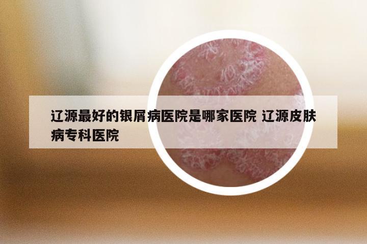 辽源最好的银屑病医院是哪家医院 辽源皮肤病专科医院
